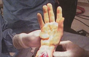 Przeszczepiono dłoń dorosłemu pacjentowi, który urodził się bez tej części ciała