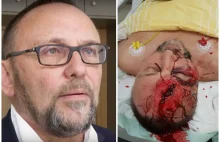 Lewacki terroryzm w Niemczech. Polityk AfD brutalnie pobity.