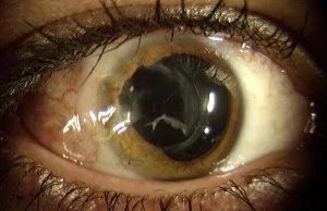 Jak wygląda oko bezpośrednio trafione kulką z paintball?