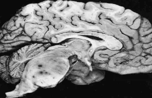 Odkryto nieznane dotąd kanaliki między czaszką a mózgiem