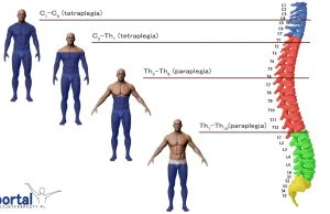 Paraplegia