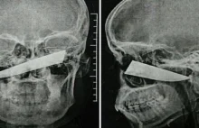 Mężczyzna przez dwa dni nie wiedział, że do głowy ma wbity nóż