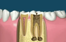 Jak wygląda leczenie kanałowe.