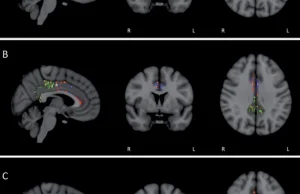 Udało się cofnąć Alzheimera o rok.