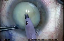 Operacja katarakty oka.