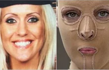 5 lat po podpaleniu, zdecydowała się ściągnąć maskę i pokazać twarz.