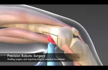 Nowa metoda usuwania raka kości - przyszłość druku 3D i chirurgii robotowej