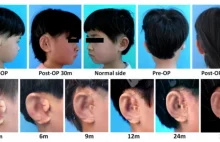 Chińczycy wyhodowali chorym dzieciom... nowe uszy na ich własnym ciele!