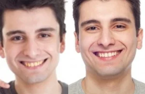 Whitetime - efekt żółtych zębów z photoshopa