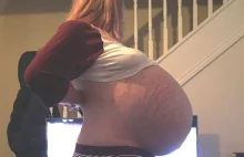 "Ciążowy brzuch" kobiety okazał się być 25-kilogramową cystą na jajniku