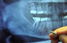 Szokujący związek: kanały korzeni zębowych i rak