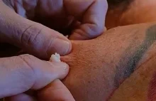 POP'S HUGE CYST LIKE PIMPLE