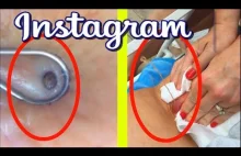 Top 20 BEST Videos from Instagram "All pimples channel"