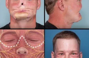 Przeszczep twarzy - "przed i po" operacji