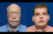 Przeszczepy twarzy które zmieniły życie pacjentów!