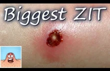 BIGGEST ZIT ON HAND "Mr.ZIT"