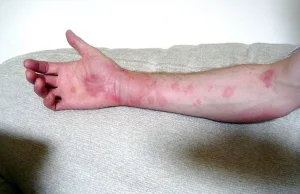 Próbujesz łagodzić objawy alergii wapnem? Specjaliści: to nie ma sensu.