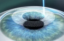 [AMA] Laserowa korekcja wzroku- wrażenia po kilku dniqch od zabiegu
