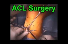 Operacja odbudowy więzadła krzyżowego przedniego (ACL)