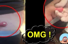 OMG!!! POPPING Shock CYST on ASS "mrZit"