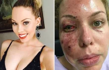 Model claims she was left disfigured after drug raid in Queensland