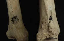 Trepanation! Not Just For Headaches: Tibial Surgery in Ancient Peru