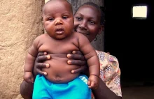 Afryka zagrożona... chorobliwą otyłością