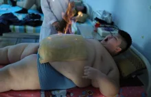 Chiny: zabieg z użyciem ognia hitem wśród terapii odchudzających