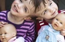 Lekarze są oszołomieni: bliźnięta syjamskie potrafią wymieniać myśli