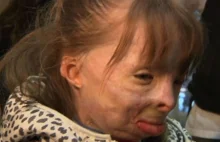 Safyre Terry, 8-latka poparzona w pożarze dostała 300 tys. listów ale nie tylko.