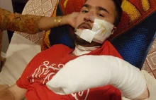 Smartfon Samsunga eksplodował raniąc twarz niepełnosprawnego mężczyzny