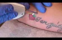 Laser usuwający tatuaż wypala matrycę aparatu.