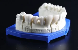 Jak uzupełnić braki zębowe? Część 2. - mosty!