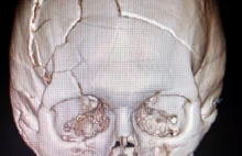 Zdjęcie czaszki user'a Reddit'a uszkodzonej po wybuchu filtra basenowego