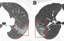 Lekarze pokazali zdjęcia płuc 33 letniej pacjentki zarażonej koronawirusem