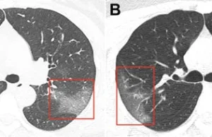 Lekarze pokazali zdjęcia płuc 33 letniej pacjentki zarażonej koronawirusem