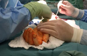 Wrocławscy chirurdzy przyszyli rękę 32-latkowi, który ręki nigdy nie miał