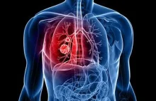Polskie sieci neuronowe potrafią diagnozować raka płuc