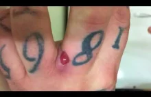 Infected Finger Abscess