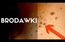 Dermatolog mówi o: BRODAWKI