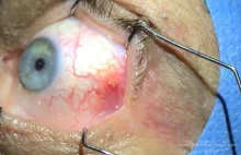 Chirurgiczne usunięcie z oka dużej cysty