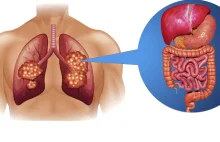 W nowotworze płuc natrafiono na miniaturowy układ trawienny.