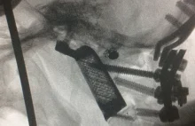 Lekarze po raz pierwszy wszczepili człowiekowi dwa wydrukowane w 3D kręgi szyjne