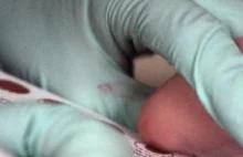 Kubuś urodził się ważąc 820 gram - uratowała go terapia nerkozastępcza