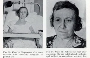 Szokujące zdjęcia przed i po lobotomii – skąd się brały zmiany u jej ofiar?