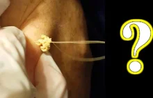HUGE 30-year-old CYST Removed ! "mrZit"