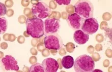 Zastosowanie CBD przy ostrej białaczce limfoblastycznej ALL (wywiad z ojcem
