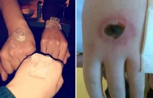 "Salt and ice challenge", czyli nowa niebezpieczna moda wśród dzieciaków