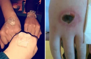 "Salt and ice challenge", czyli nowa niebezpieczna moda wśród dzieciaków