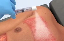 Opracowano "skórę w sprayu" do leczenia ciężkich przypadków poparzeń |...